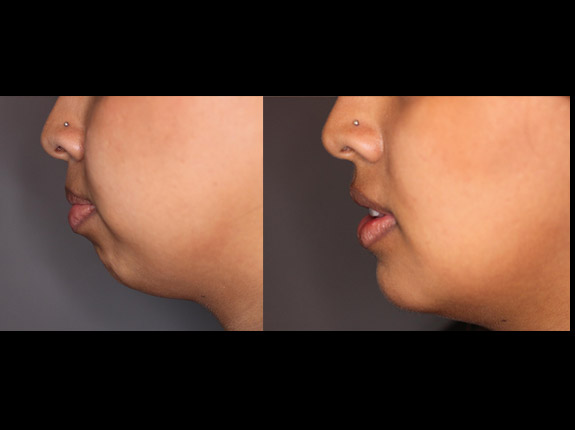 Chin-Implant-before-and-after