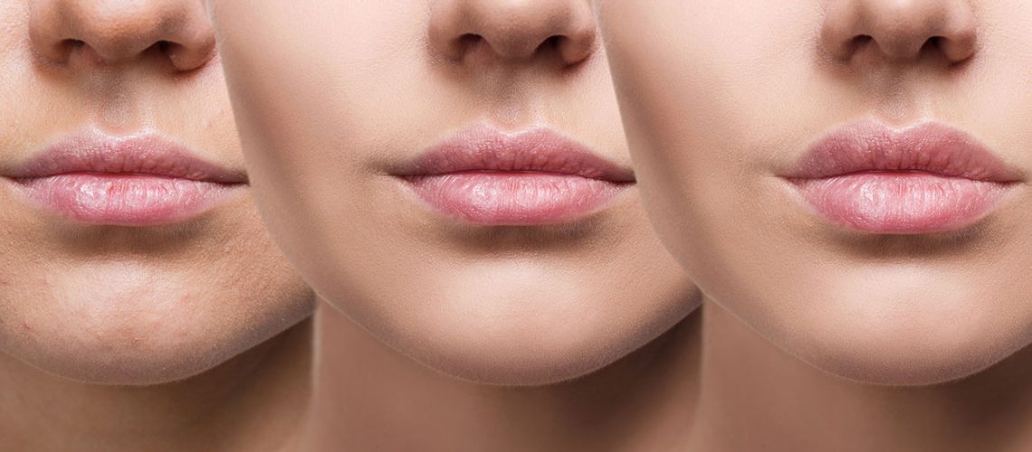 Lip-FillersLip-Augmentation-by-Dermal-Fillers